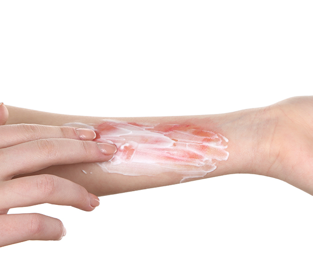 Reston Rash and Burn Treatment